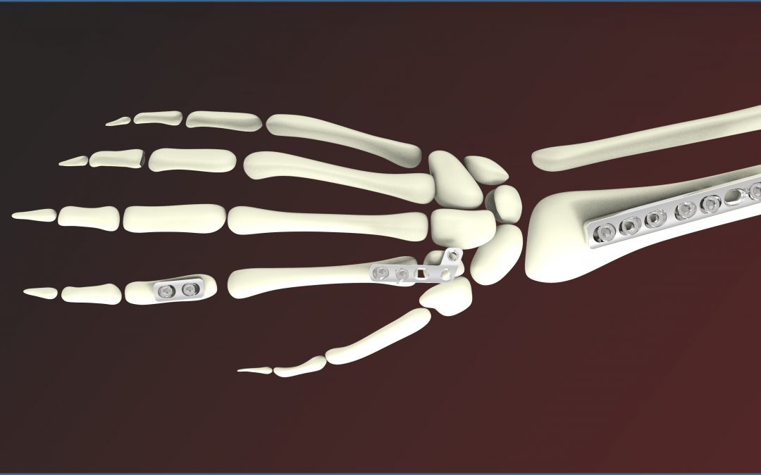 Precision Casting for Medical Industries